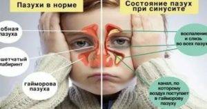 Психосоматика у детей: таблица заболеваний, причины болезней аденоидов, насморка и кашля, аллергии и энуреза