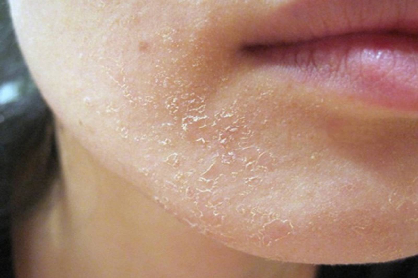 Лицо шелушится: что делать, как избавиться от шелушения и восстановить кожу с помощью различных средств