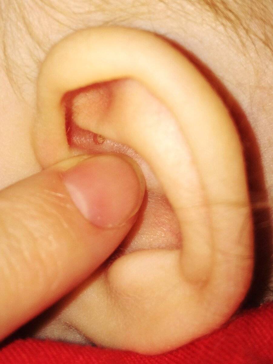 Болит верхняя часть ушной раковины