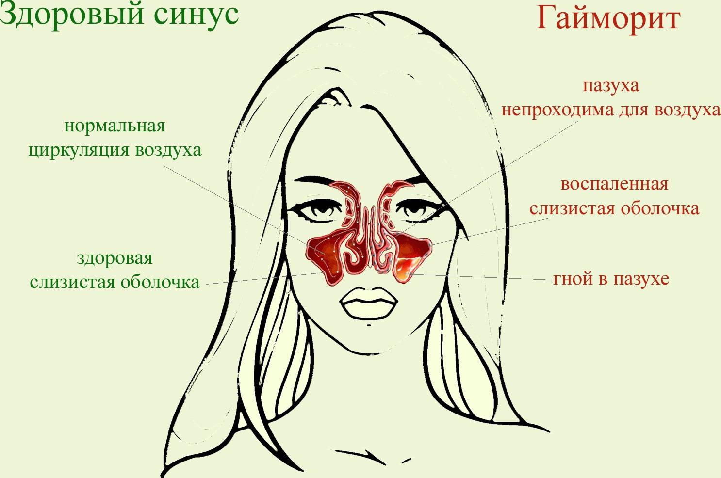 Болячки в носу: причины боли, лечение мазями и народными средствами