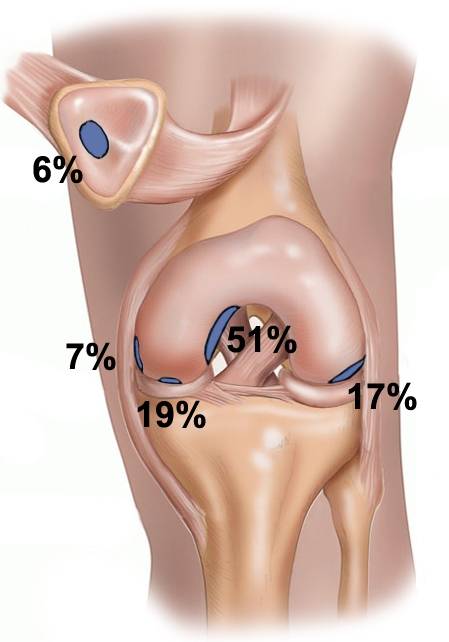 Болезнь кенига коленного сустава операция