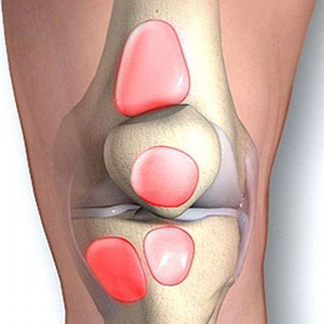 Симптомы и лечение супрапателлярнного бурсита коленного сустава
