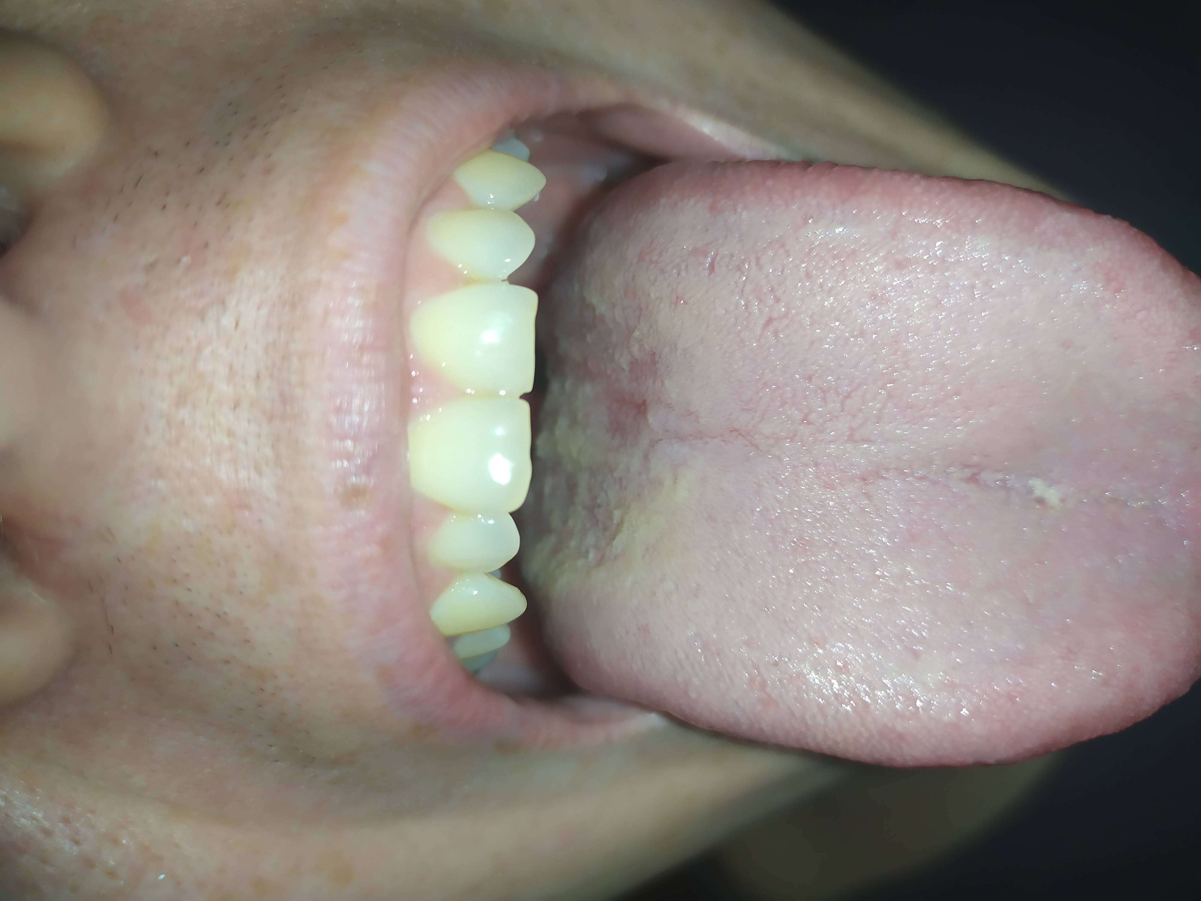 Синий налет на языке при коронавирусе, после вина, химиотерапии
