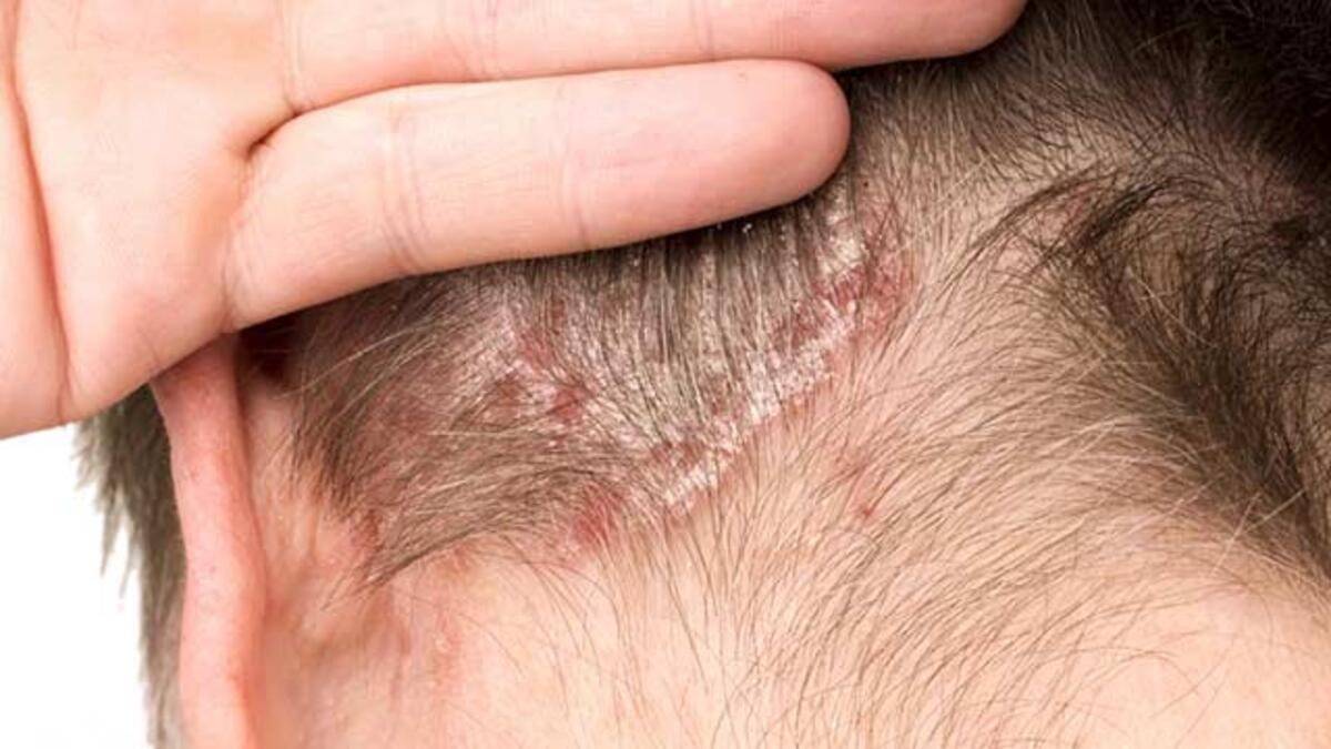 Шелушение, сухая кожа, корочки в ушах – причины, фото и лечение