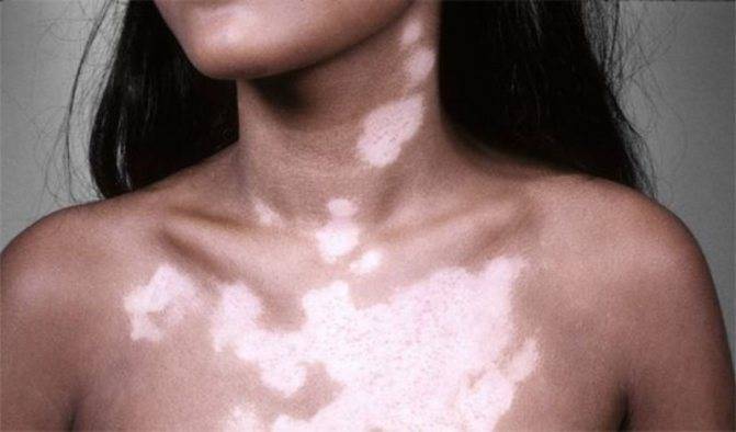 Почему появились белые пятна на коже у ребенка, их виды и лечение