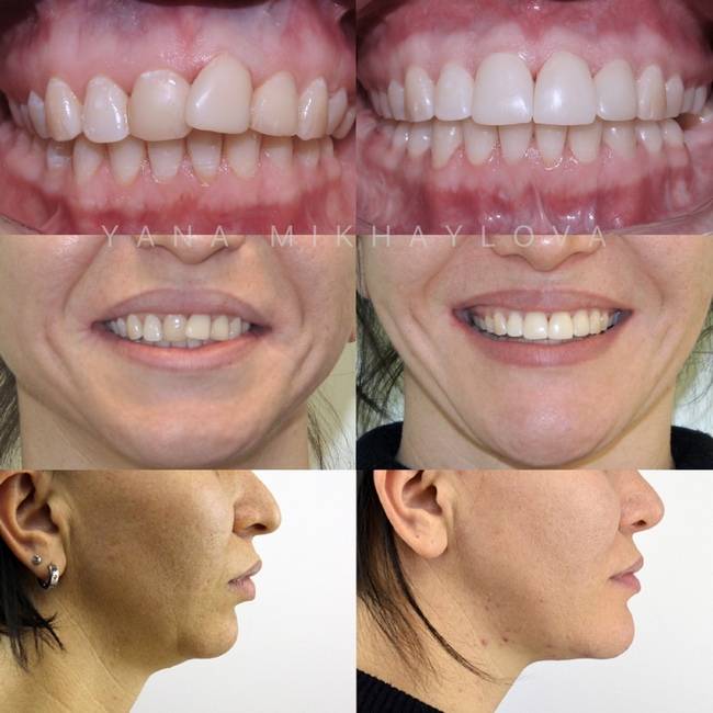 Брекеты до и после — фото зубов после снятия конструкций