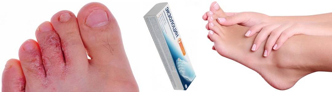Трещины на пальцах ног - почему появляются, как лечить раны препаратами и народными средствами, профилактика поражения кожи