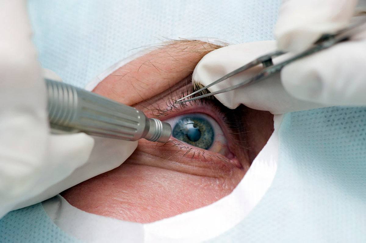 Вам поставили диагноз катаракта глаза? что это такое и как жить дальше