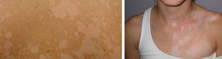 Нарушение пигментации кожи: причины появления пигментных пятен на теле