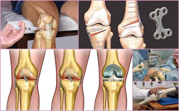 Гонартроз 3 степени коленного сустава лечение методика бубновского