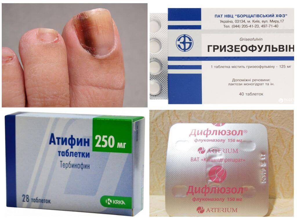 Грибок ногтей препараты отзывы чем лечить. Таблетки от грибка ногтей. Таблетки от грибка ногтей на ногах. Капсулы от грибка ногтей.