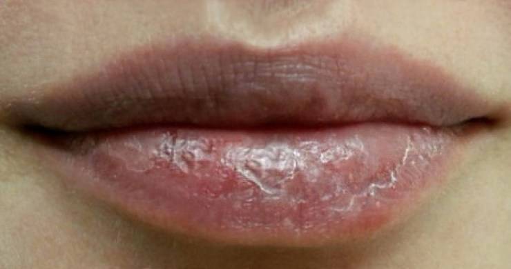 Почему сохнут и трескаются губы — причины