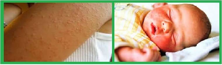 Аллергия на глютен у ребёнка и взрослого: симптомы, как проявляется, фото и лечение аллергической реакции организма