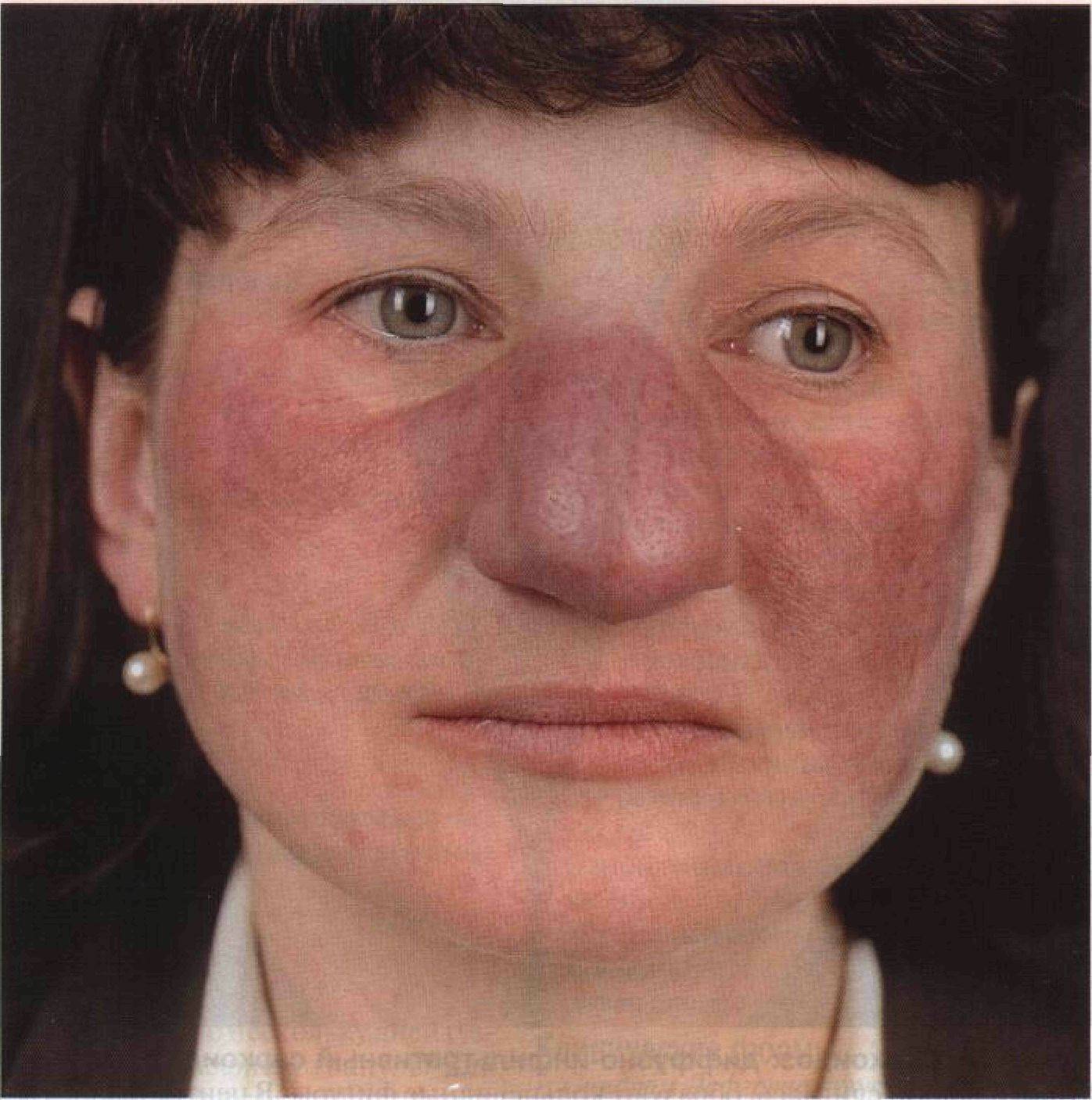 Стрептодермия кожи лица фото