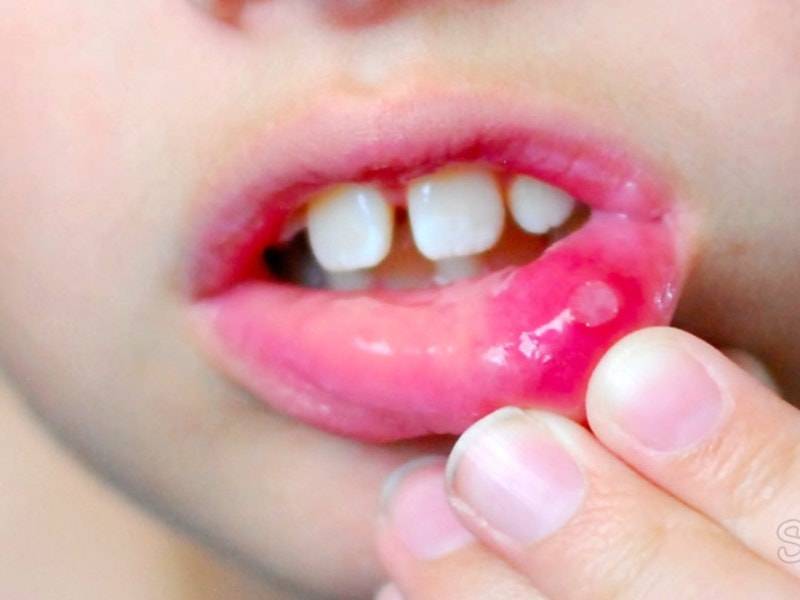 Мазь для лечения стоматита во рту для взрослых и детей, кремы и гели