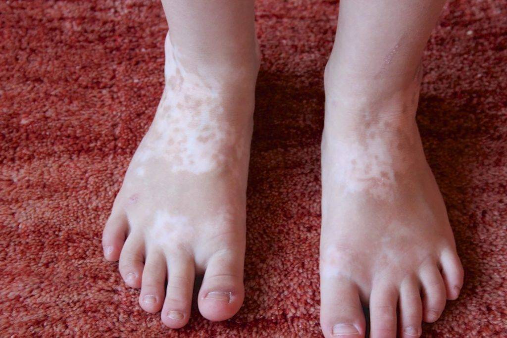 Пузырчатка: болезнь детской кожи