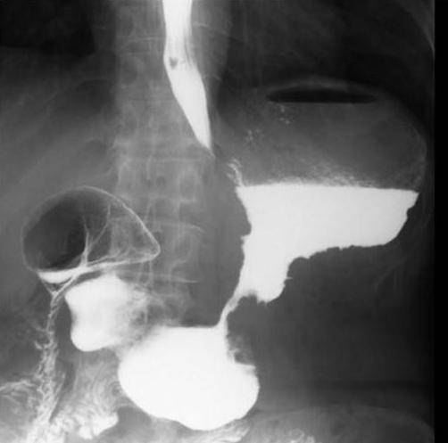 Рентген желудка с барием, с контрастом: подготовка, что показывает, рентген и фгдс