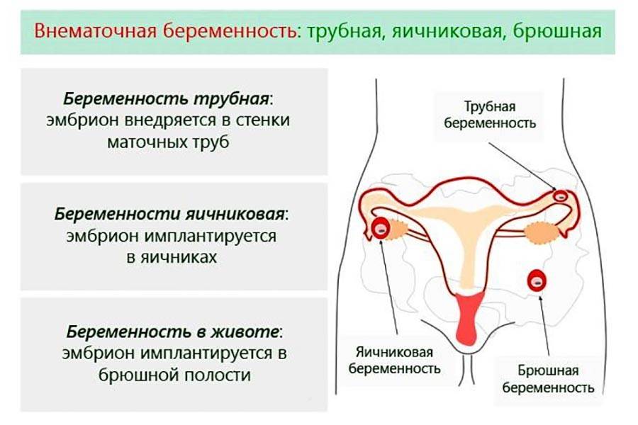 Почему болят яичники причины. Внематочная период беременности. Локализация боли при внематочной беременности. Виды внематочной беременности. Локализация трубной беременности.