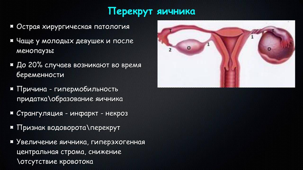 Почему боль в яичниках. Причины боли в правом яичнике. Правый яичник болит у женщины. Болит левый яичник у женщины.