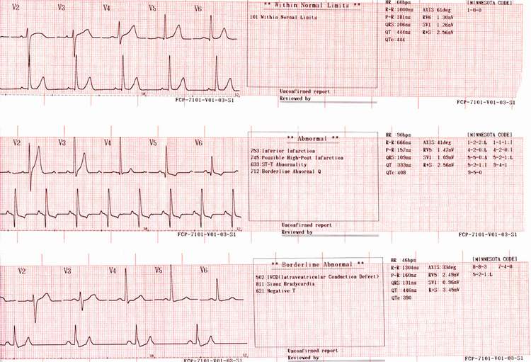 Синусовый ритм сердца: расшифровка кардиограммы
