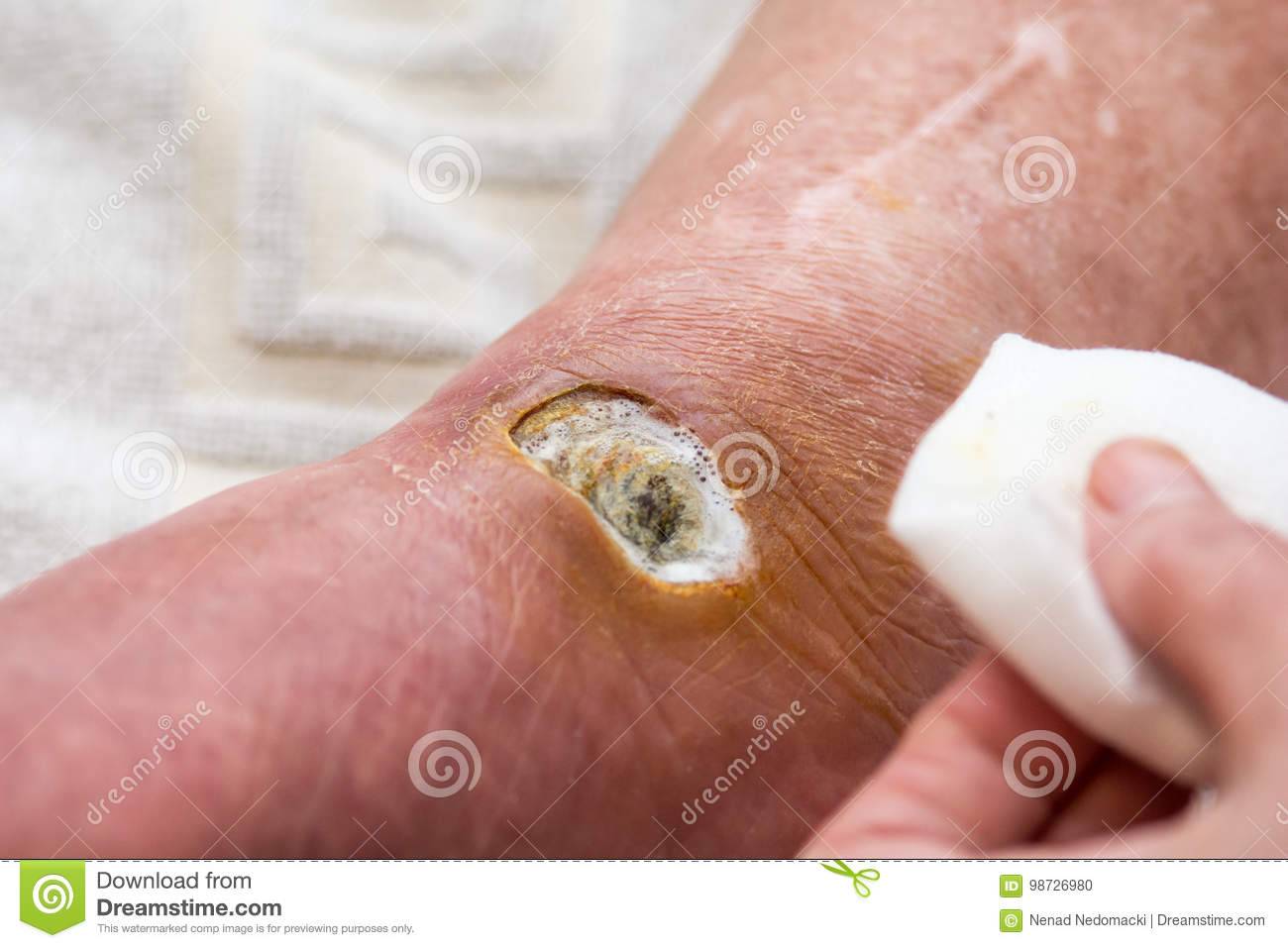 Гангрена ноги фото начальная стадия при сахарном диабете - все про гипертонию