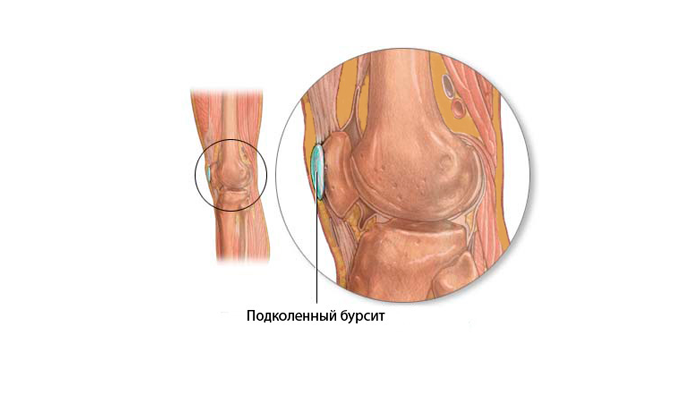 Препателлярный бурсит коленного сустава: симптомы и лечение