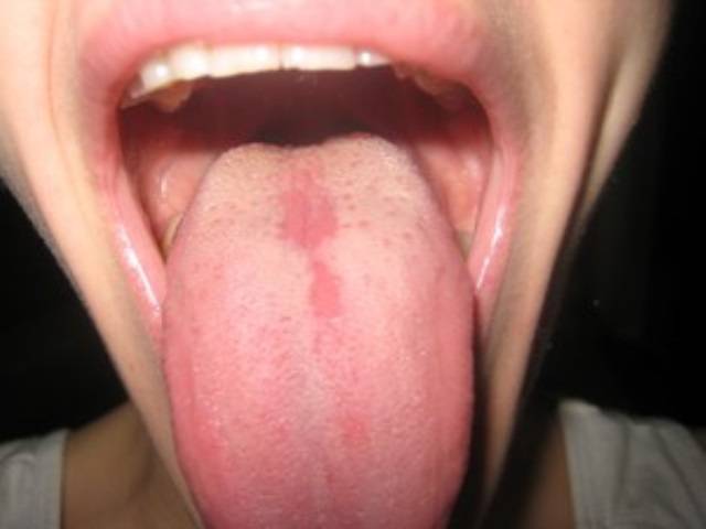 Почему у ребенка болит язык, поднимается температура — что делать