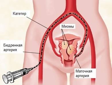 Эмболизация маточных артерий (эма) : показания и противопоказания, последствия, цена | vrachmatki