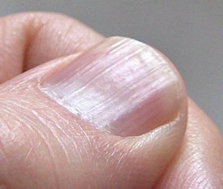 Полоски на ногтях: причины, диагностика и лечение симптоматики
