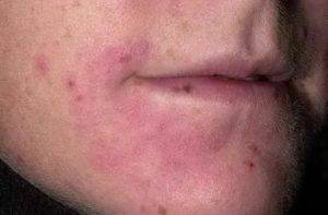 Периоральный дерматит на лице фото лечение мази и кремы