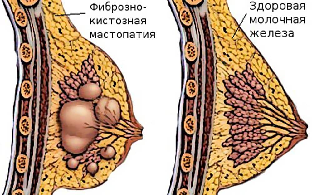 Железисто кистозная мастопатия: причины, диагностика и лечение
