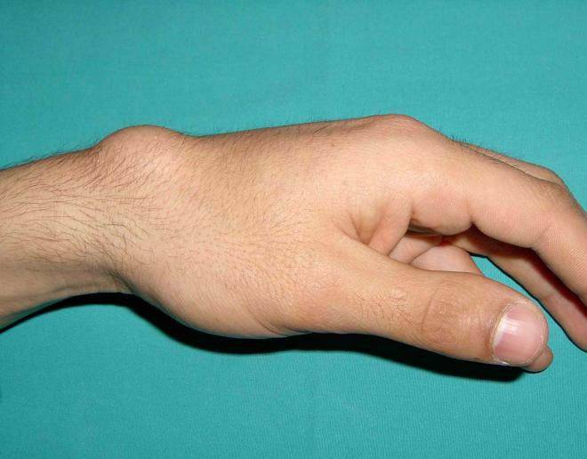 Гигрома на руке - кисти, запястье, пальцах: причины, фото, способы лечения, профилактика