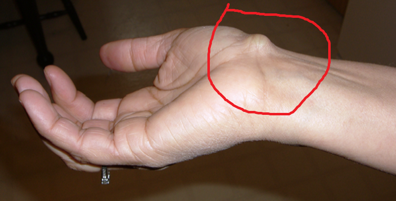 Гигрома на пальце руки - признаки, как лечить медикаментозно, хирургически и народными средствами