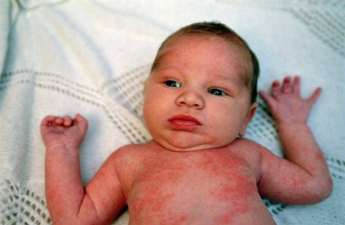 Потница у новорожденных – как не перепутать с аллергией и быстро устранить сыпь?