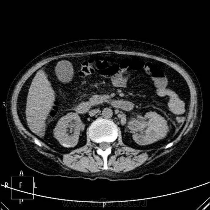 Мрт почек и мочевыводящих путей: что показывает томография, правила подготовки к исследованию, современная безопасная контрастная диагностика