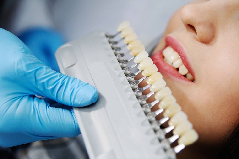 отбеливание зубов в стоматологии цена в рязани