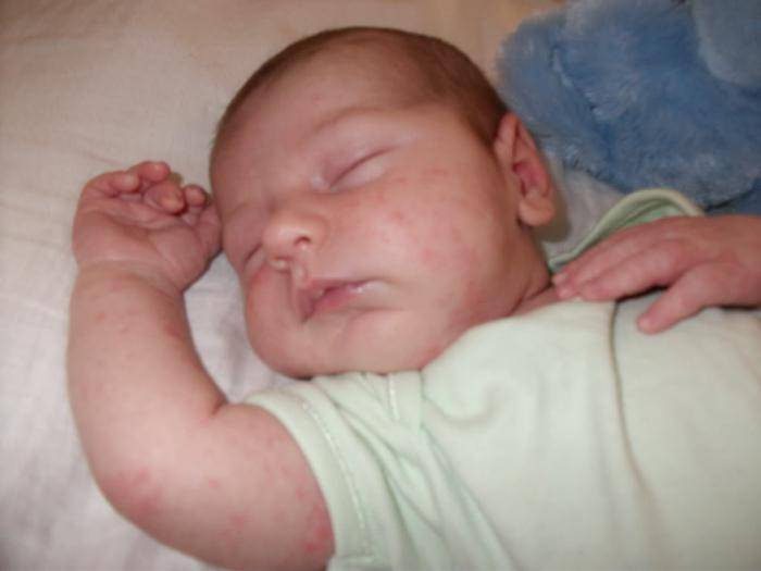 Потница у новорожденных (33 фото): как выглядит инфицированная потничка, каковы симптомы у грудничка, в 8 месяцев и до года, виды и как проявляется