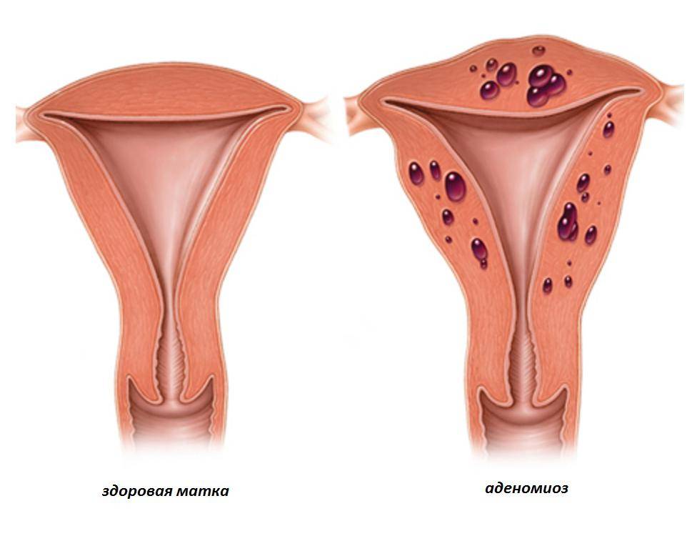 Эффективное лечение эндометриоза у женщин препаратами и народными средствами