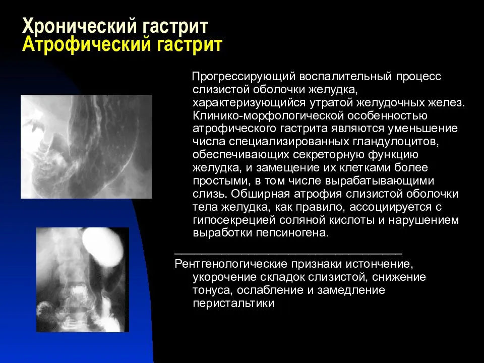 Хронический атрофический гастрит: симптомы и лечение | vrednuga.ru