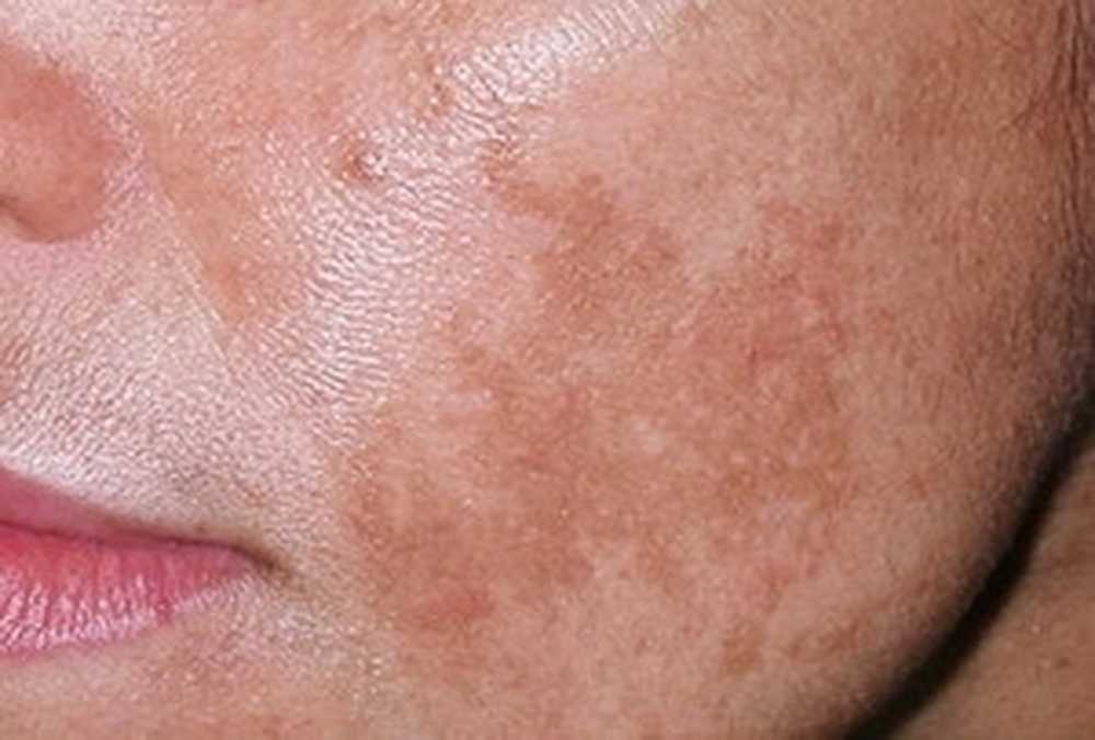 Пигментация кожи на лице: виды и способы лечения