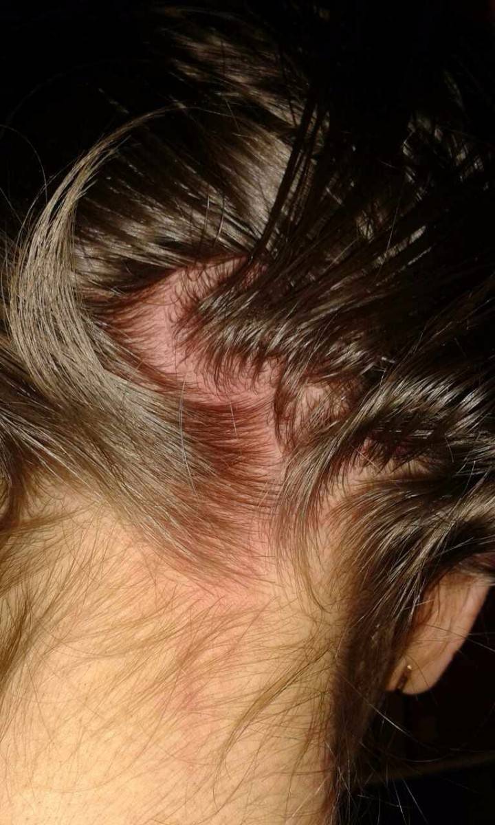 Прыщи на голове в волосах у мужчин: причины и лечение | moninomama.ru