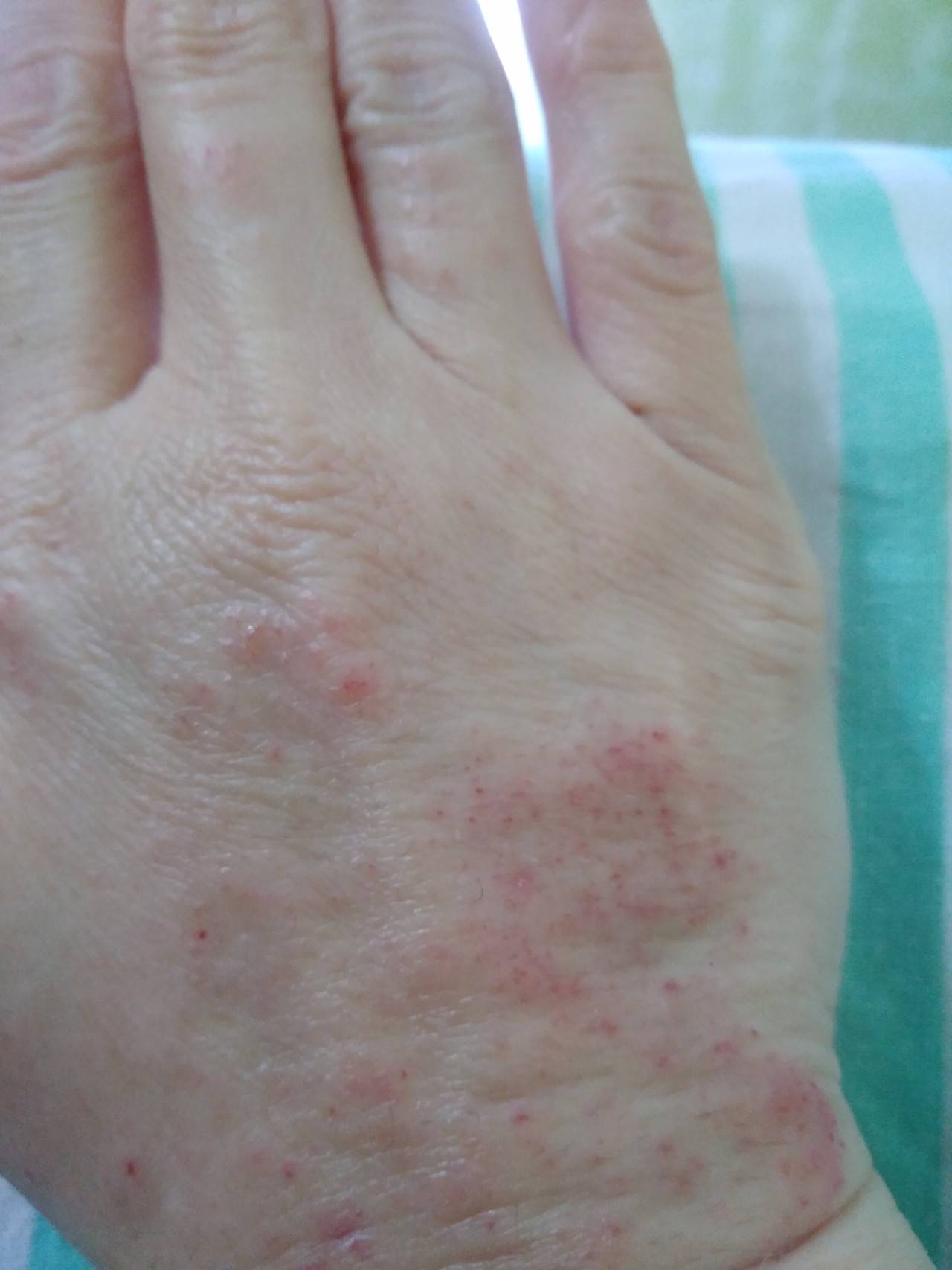 Сыпь на лице у взрослых женщин (мелкая, красная):причины, как убрать высыпания на коже?