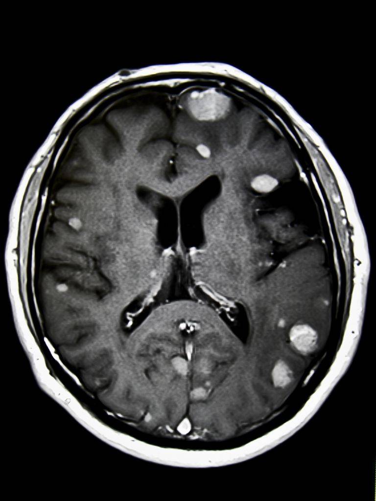 Метастазы в головном мозге: продолжительность жизни, симптомы, лучевая терапия при метастазах мозга