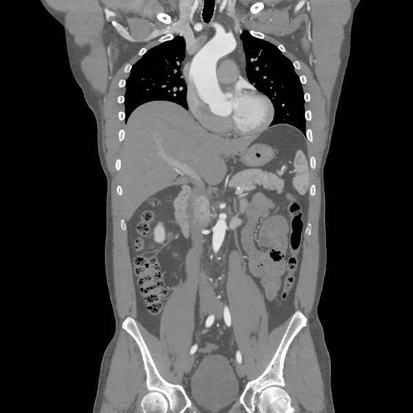 Компьютерная томография органов брюшной полости: показания, противопоказания, подготовка к процедуре
