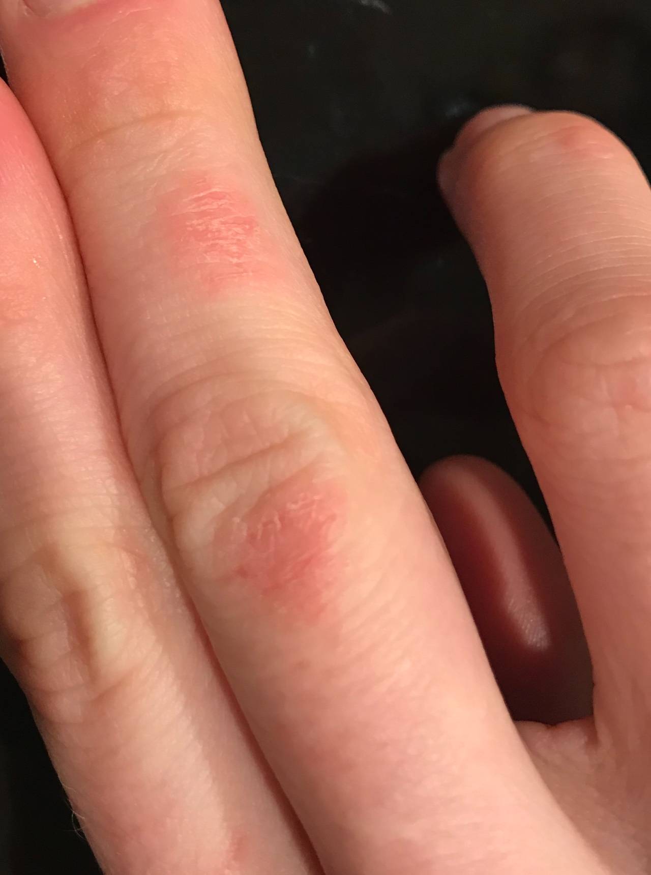 10 причин возникновения трещин на коже рук. лечение