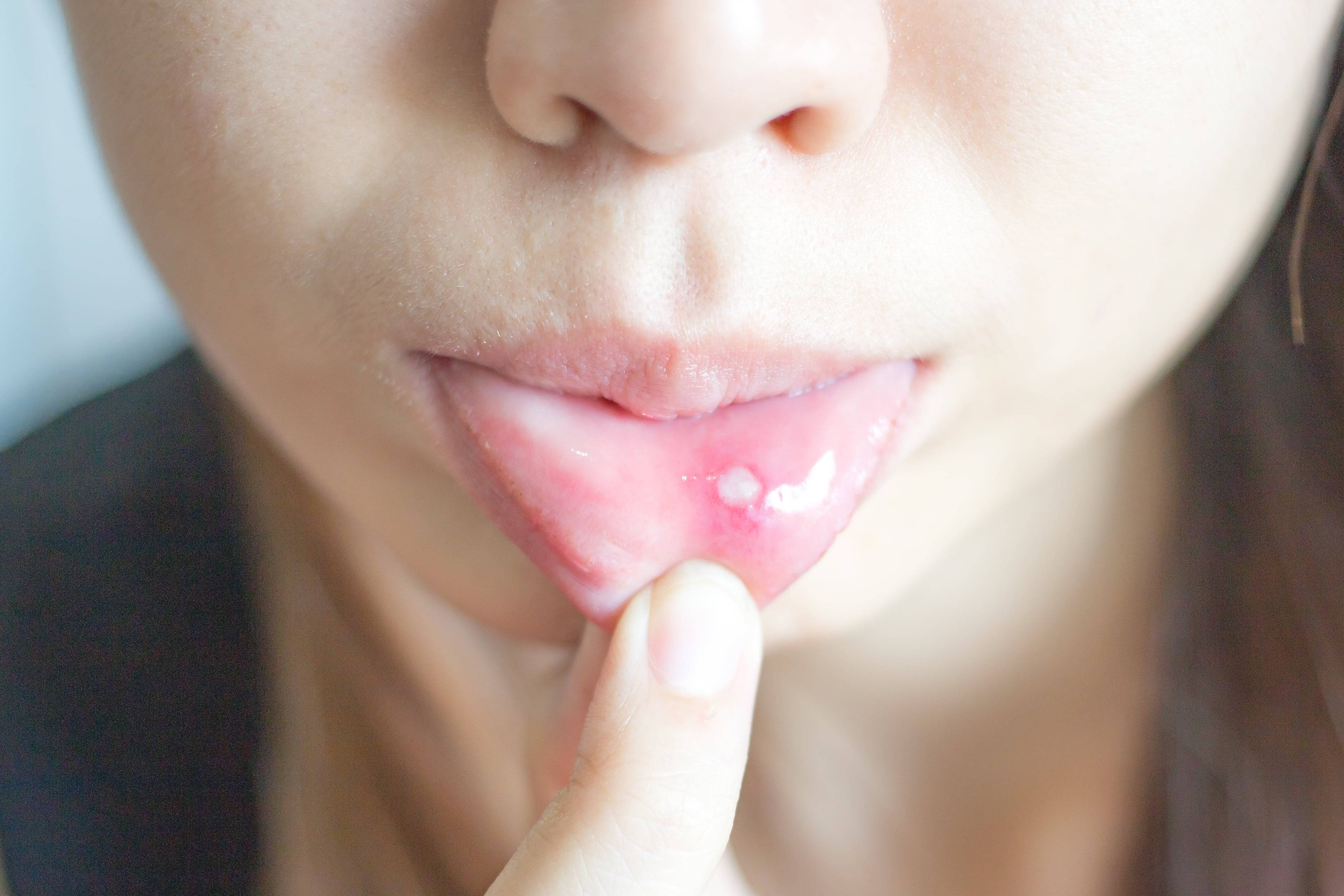 Стоматит во рту — чем лечить? основные симптомы болезни