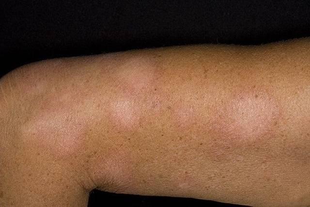 Дерматомикоз: что это такое и как лечится инфекционное заболевание кожи