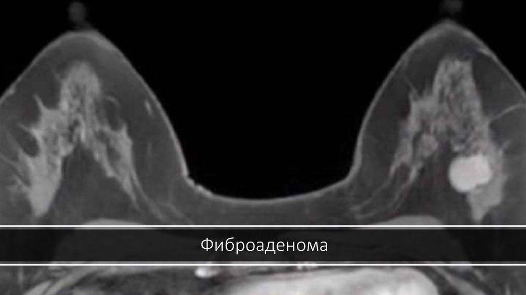 Интраканаликулярная фиброаденома молочной железы: симптомы и первые признаки
