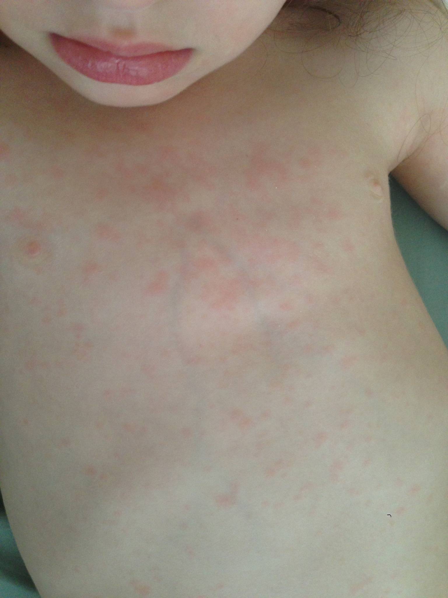 Энтеровирусная инфекция у ребенка: симптомы и лечение, сыпь (фото), комаровский