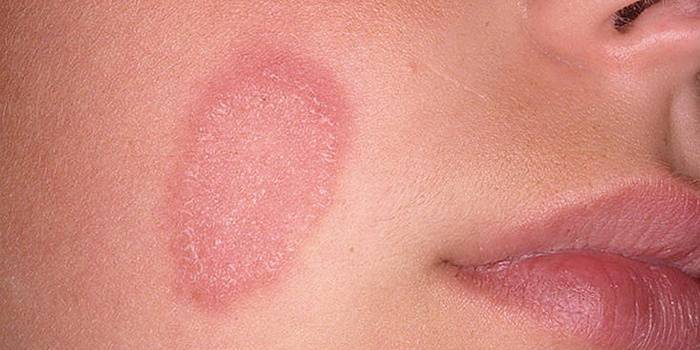 Инструкция для аллергиков: как избавиться от сыпи на лице?
